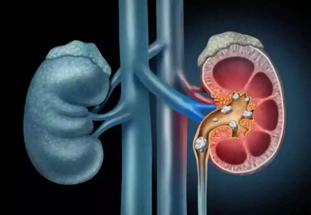  Kidney diseases